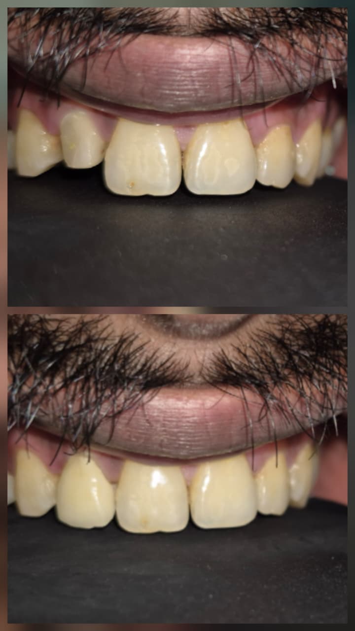 Before and after smile transformation 9